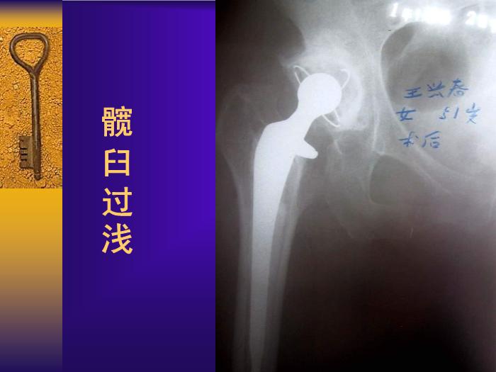 【醫學PPT課件】全髖關節置換手術的常見失誤及其預防第14頁