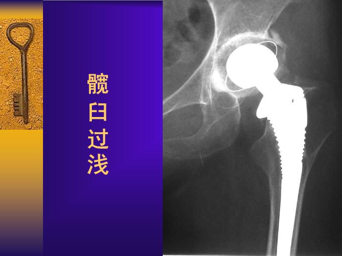 【醫學PPT課件】全髖關節置換手術的常見失誤及其預防第15頁