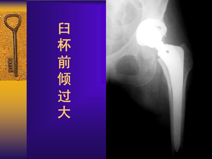 【醫學PPT課件】全髖關節置換手術的常見失誤及其預防第7頁