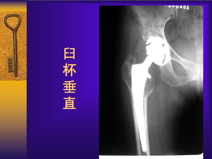 【醫學PPT課件】全髖關節置換手術的常見失誤及其預防第8頁