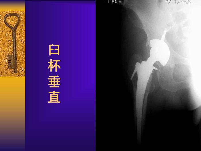 【醫學PPT課件】全髖關節置換手術的常見失誤及其預防第9頁