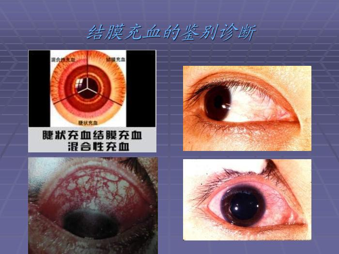 【醫學PPT課件】急性閉角型青光眼 黃驊市醫院眼科第14頁