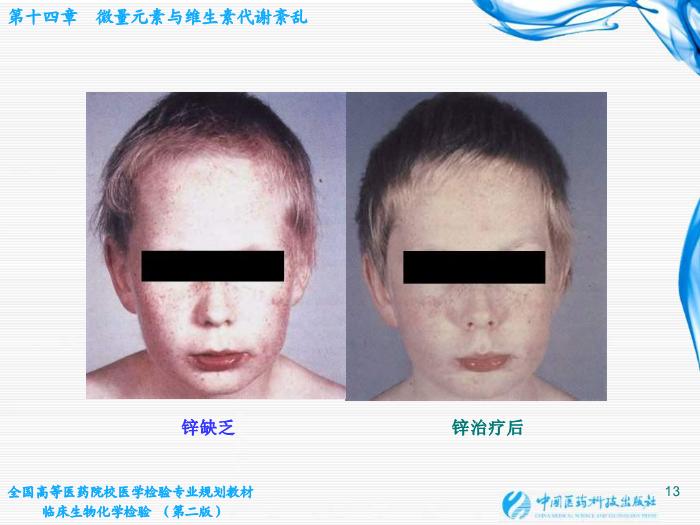 【醫學PPT課件】第14章  微量元素與維生素代謝紊亂第13頁