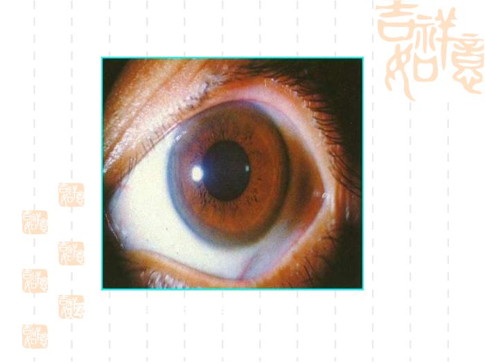 【醫學PPT課件】肝豆狀核變性的診斷與治療指南第4頁
