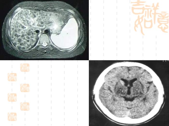 【醫學PPT課件】肝豆狀核變性的診斷與治療指南第7頁