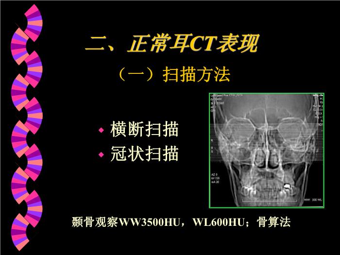 【醫學PPT課件】耳部CT解剖及疾病診斷_王麗君PPT課件第10頁