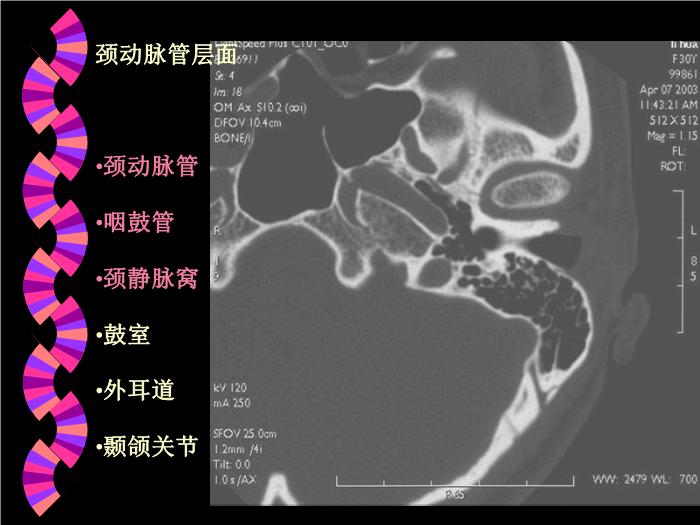 【醫學PPT課件】耳部CT解剖及疾病診斷_王麗君PPT課件第13頁