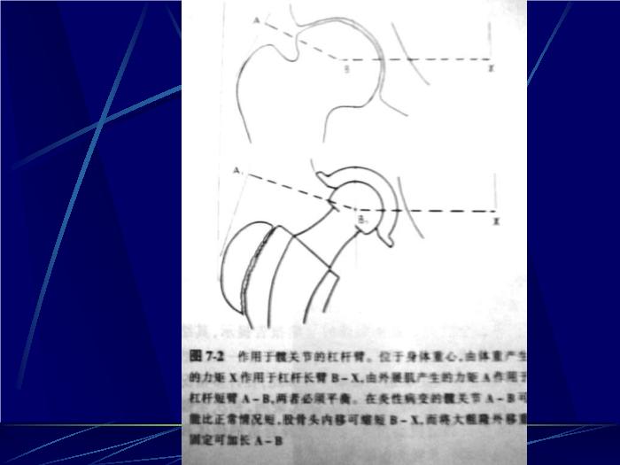 【醫學PPT課件】人工髖關節置換術 南京醫科大學第一附屬醫院骨科第10頁
