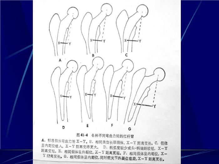 【醫學PPT課件】人工髖關節置換術 南京醫科大學第一附屬醫院骨科第12頁