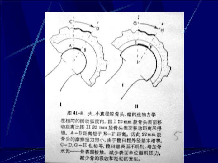 【醫學PPT課件】人工髖關節置換術 南京醫科大學第一附屬醫院骨科第14頁
