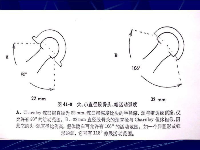 【醫學PPT課件】人工髖關節置換術 南京醫科大學第一附屬醫院骨科第15頁