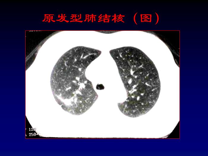 【醫學PPT課件】第四章呼吸系統-肺結核影像診斷_PPT課件第11頁