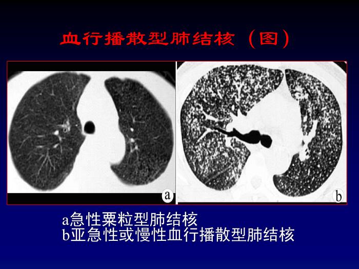 【醫學PPT課件】第四章呼吸系統-肺結核影像診斷_PPT課件第14頁