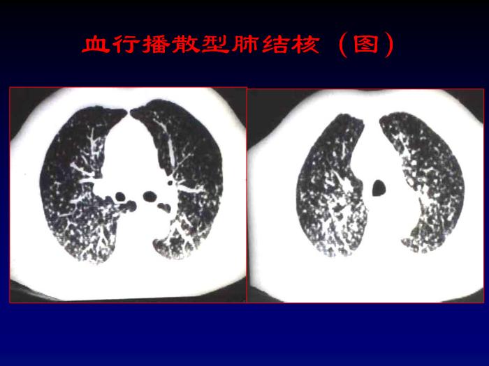 【醫學PPT課件】第四章呼吸系統-肺結核影像診斷_PPT課件第15頁