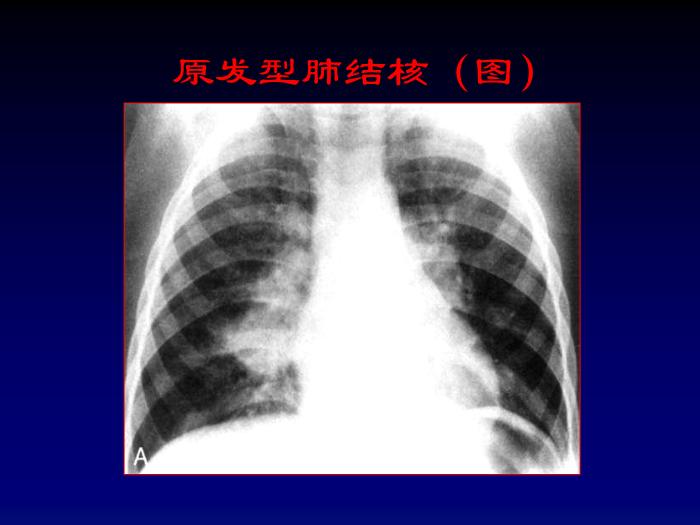 【醫學PPT課件】第四章呼吸系統-肺結核影像診斷_PPT課件第8頁