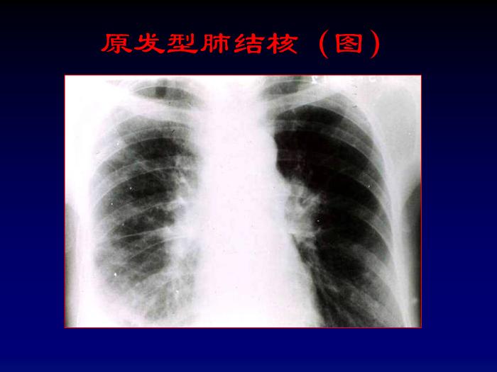 【醫學PPT課件】第四章呼吸系統-肺結核影像診斷_PPT課件第9頁
