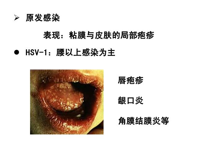【醫學PPT課件】第31章 皰疹病毒 醫學微生物學教學課件第11頁