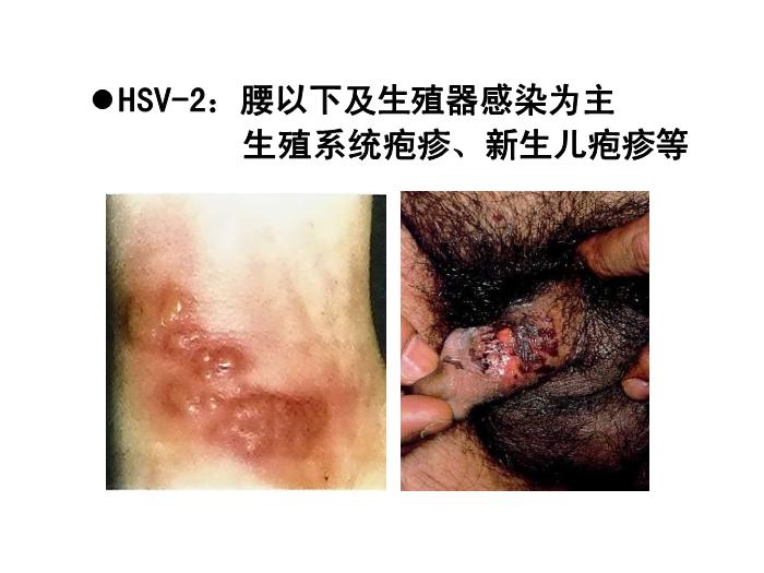 【醫學PPT課件】第31章 皰疹病毒 醫學微生物學教學課件第12頁