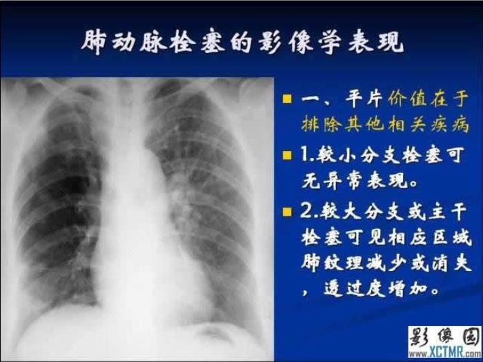 【醫學PPT課件】肺栓塞與肺梗死的影像學診斷_PPT課件第14頁