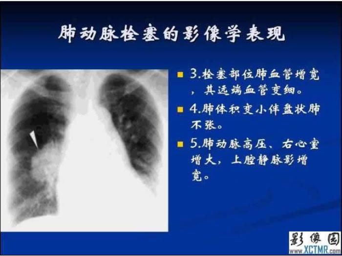 【醫學PPT課件】肺栓塞與肺梗死的影像學診斷_PPT課件第15頁