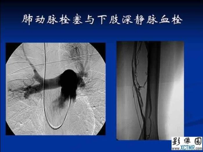 【醫學PPT課件】肺栓塞與肺梗死的影像學診斷_PPT課件第5頁