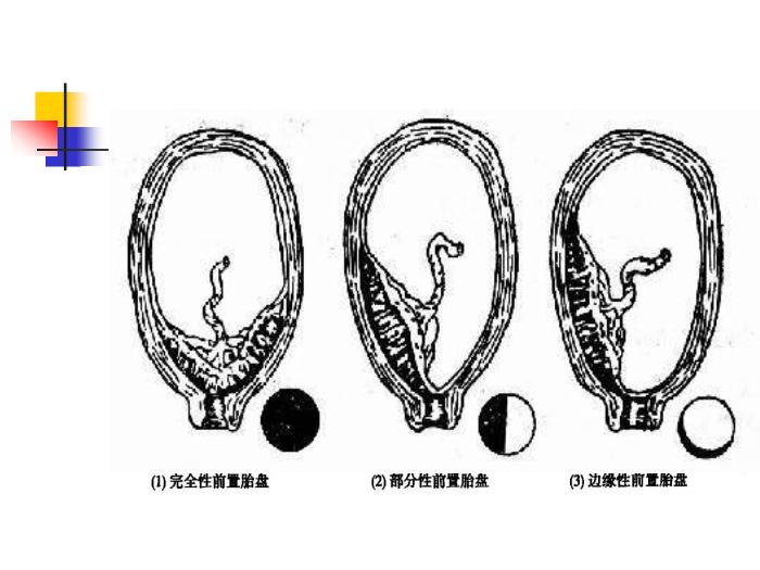 【醫學PPT課件】前置胎盤placenta previa課件第10頁