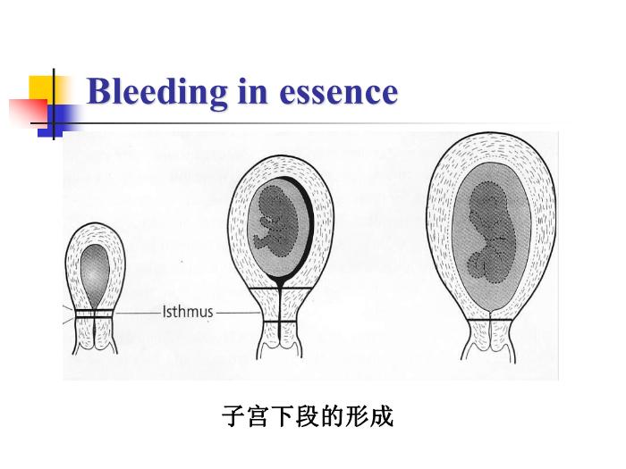 【醫學PPT課件】前置胎盤placenta previa課件第13頁