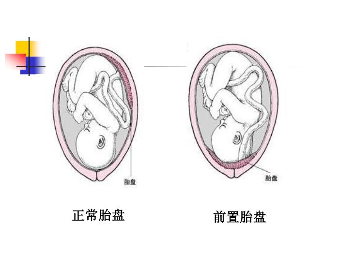 【醫學PPT課件】前置胎盤placenta previa課件第3頁