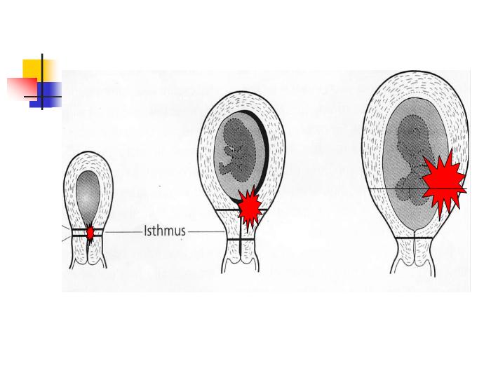 【醫學PPT課件】前置胎盤placenta previa課件第6頁