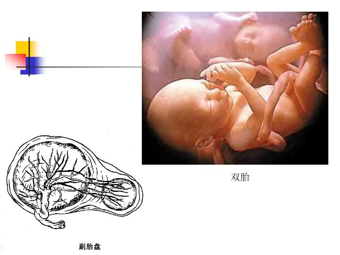 【醫學PPT課件】前置胎盤placenta previa課件第8頁