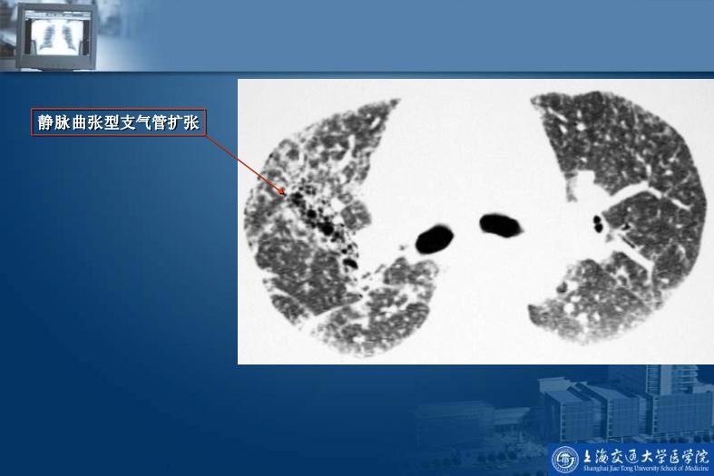 【醫學PPT課件】呼吸系統影像學診斷_PPT課件第9頁