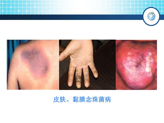 【醫學PPT課件】念珠菌病 傳染病學教學課件第11頁