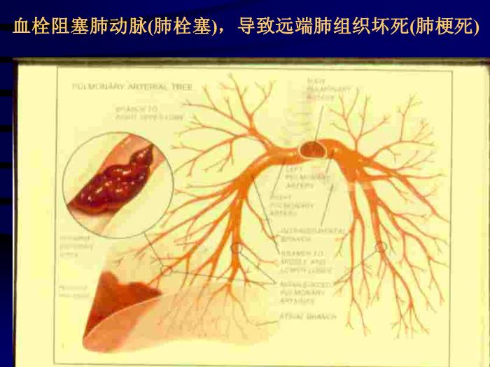 【醫學PPT課件】肺栓塞的診斷和治療-昆明市第一人民醫院呼吸科-鄭勤玲第11頁