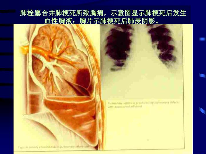 【醫學PPT課件】肺栓塞的診斷和治療-昆明市第一人民醫院呼吸科-鄭勤玲第13頁