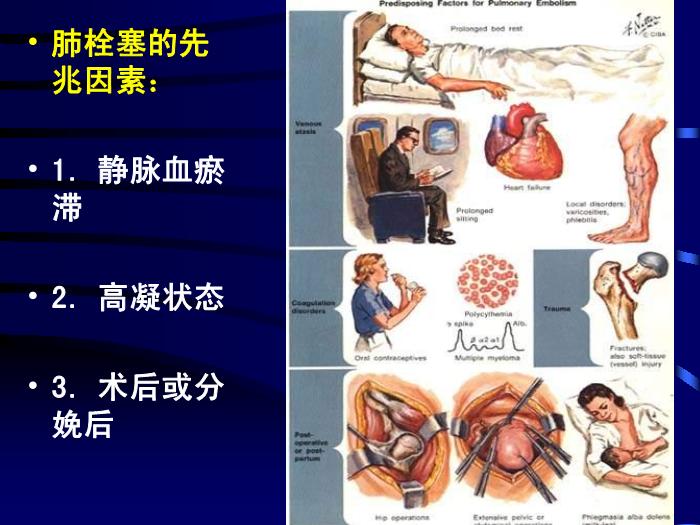 【醫學PPT課件】肺栓塞的診斷和治療-昆明市第一人民醫院呼吸科-鄭勤玲第5頁