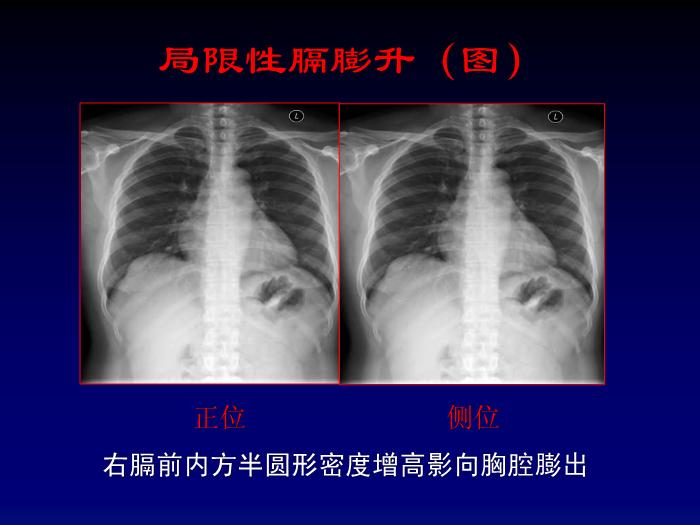 【醫學PPT課件】第四章呼吸系統-膈肌病變影像診斷_PPT課件第12頁