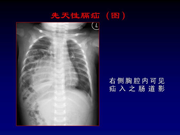 【醫學PPT課件】第四章呼吸系統-膈肌病變影像診斷_PPT課件第8頁