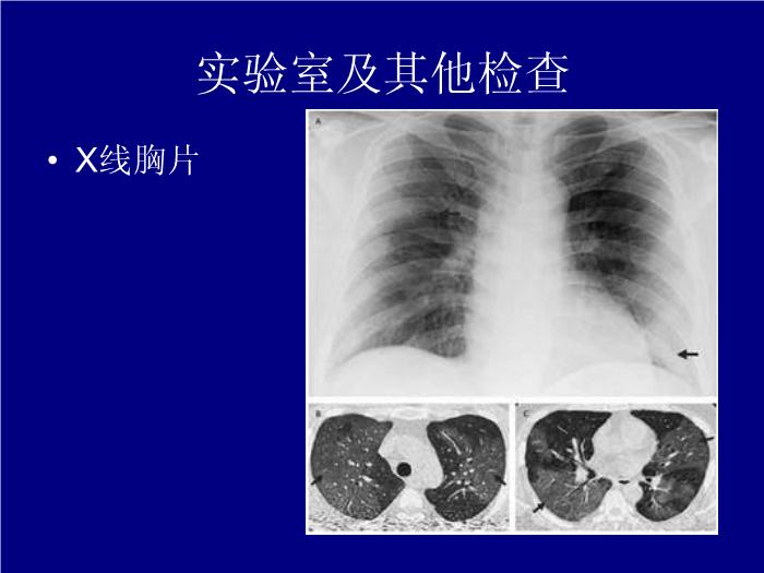 【醫學PPT課件】急性呼吸窘迫綜合征-武漢大學第一臨床學院-曹霞第12頁