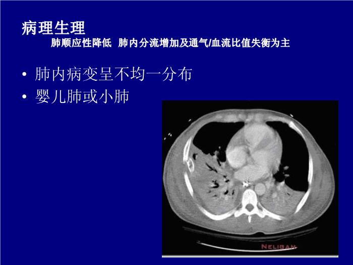 【醫學PPT課件】急性呼吸窘迫綜合征-武漢大學第一臨床學院-曹霞第9頁