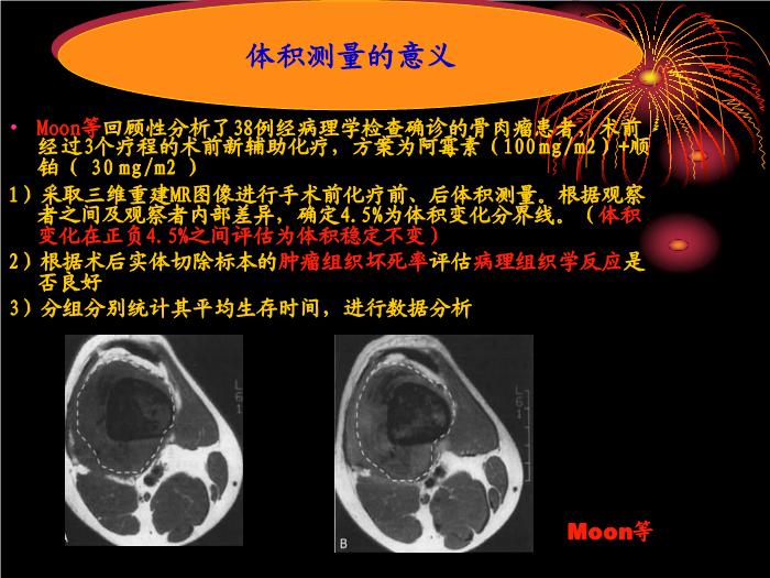 【醫學PPT課件】骨肉瘤治療中體積測量的方法和價值  天津骨科醫院腫瘤科第10頁