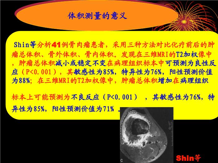 【醫學PPT課件】骨肉瘤治療中體積測量的方法和價值  天津骨科醫院腫瘤科第12頁