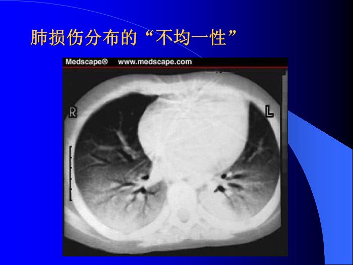 【醫學PPT課件】急性肺損傷-急性呼吸窘迫綜合征-危重醫學科第9頁