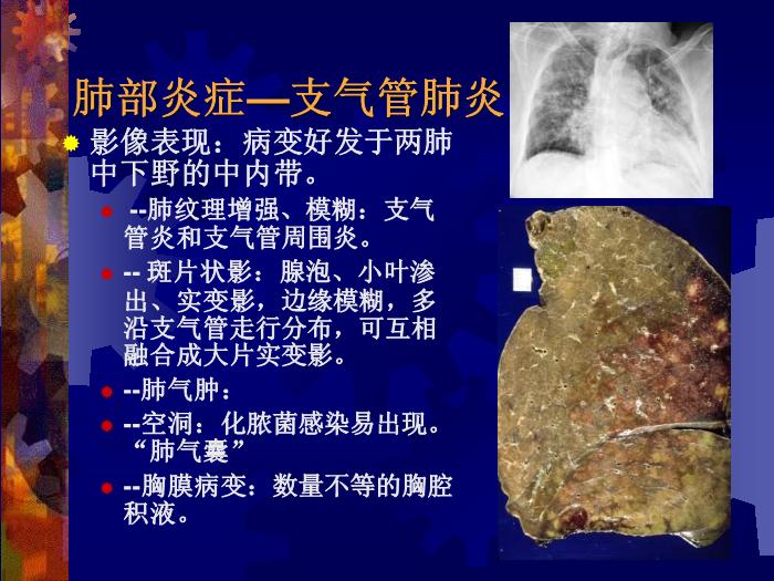 【醫學PPT課件】肺部炎癥課件-天鐵醫院放射中心-PPT課件第11頁