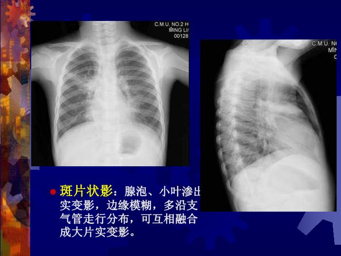 【醫學PPT課件】肺部炎癥課件-天鐵醫院放射中心-PPT課件第13頁