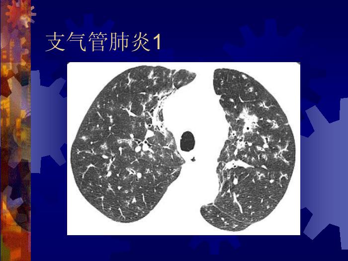 【醫學PPT課件】肺部炎癥課件-天鐵醫院放射中心-PPT課件第14頁