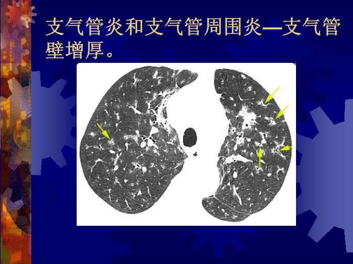【醫學PPT課件】肺部炎癥課件-天鐵醫院放射中心-PPT課件第15頁