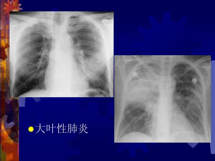 【醫學PPT課件】肺部炎癥課件-天鐵醫院放射中心-PPT課件第5頁