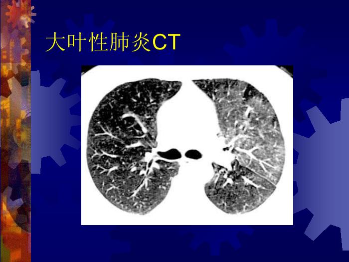 【醫學PPT課件】肺部炎癥課件-天鐵醫院放射中心-PPT課件第6頁