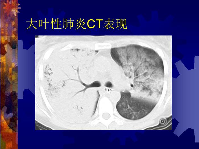 【醫學PPT課件】肺部炎癥課件-天鐵醫院放射中心-PPT課件第7頁