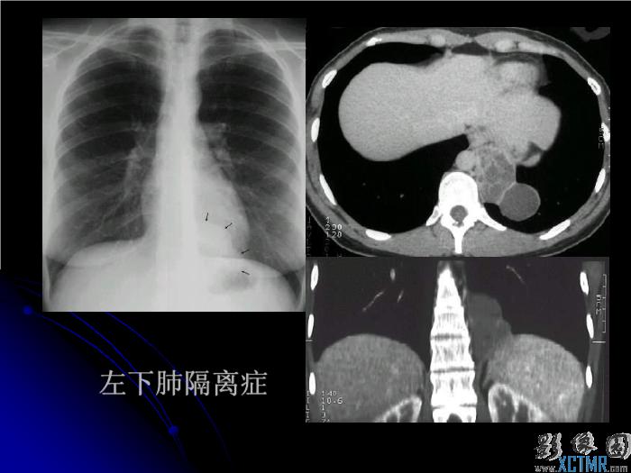 【醫學PPT課件】肺先天性疾病影像診斷_PPT課件第15頁